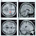 Thumbnail image for Questions About Marijuana and Schizophrenia