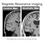 Thumbnail image for Alcohol’s Damaging Effects on the Brain